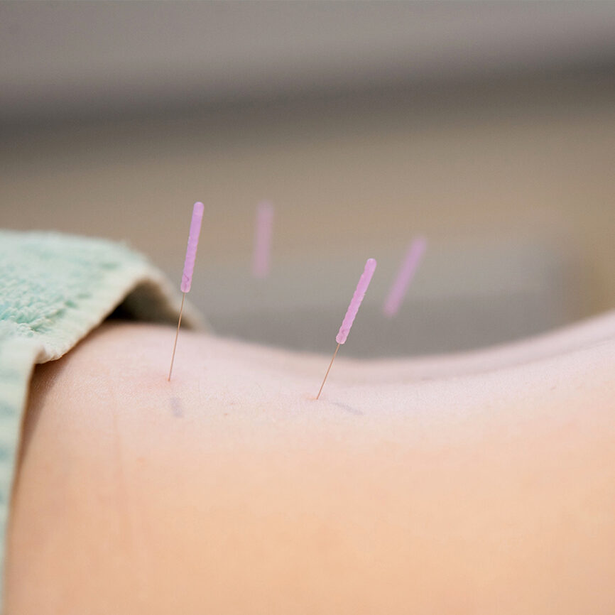 oakwood-physio-acupuncture